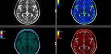 Brain scans of meditation
