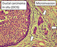 Histopathology_of_microinvasive_ductal_carcinoma_in_situ.png