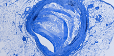 Athlerosclerosis advanced lipid pane;